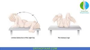 Image result for Galeazzi Sign