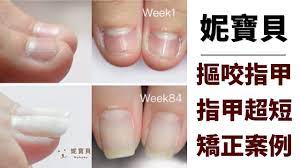 嚴重咬手指的矯正例子 指甲超短甲床萎縮指肉外露指緣紅腫發炎 nail spa nails make it yourself