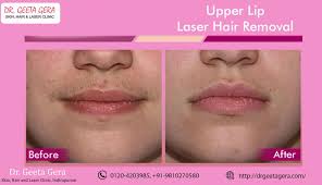 You're in and out after they gel your area and zap all of it. Laser Hair Removal Lip Off 74 Online Shopping Site For Fashion Lifestyle