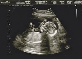 18 Week Obgyn Visit And Ultrasound Baby Ultrasound Ultrasound Pictures Baby Ultrasound Pictures