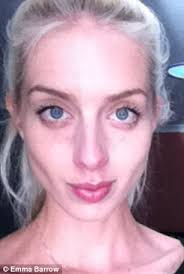 Victoria woman opens up about her battle with anorexia