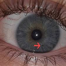 Image result for nevus sclerae