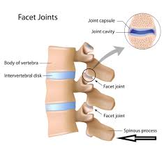 Baastrup S Sign Kissing Spine And Back Pain