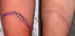 Information and advice about laser tattoo removal, removal cream, tattoo removal cost and more. Blog Spot Tatt Chat City Tattoo Removal