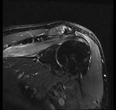 Parsonage Turner Syndrome Radiology Case Radiopaedia Org