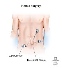 Image result for Inguinal hernia man