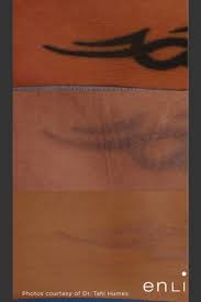 A good suggestion is to carry around an image of your tattoo for awhile, if after a few months you haven't changed your mind then you can consider getting it put on your body. Tattoo Removal On Lower Back Prejuvenation