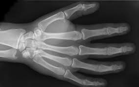 Jersey finger is the colloquial term for tearing of the tendon that bends the tip of the finger. A Look At Jersey Finger Injuries Orthopedic Implants For Tendons And Bones Toby Orthopaedics