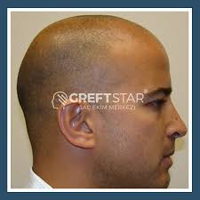 Greft Star Adli Kullanicinin Sac Ekimi Samsun Panosundaki Pin Sac