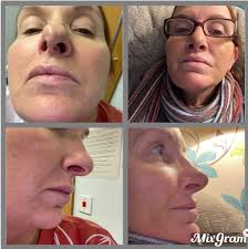 Life update: One week ago, I finally had a septoplasty—something I'd put  off for way too long. My septum was shaped like an “S” and made it nearly  impossible to breathe through