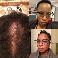 Who is a good hair stylist for post-traumatic hair stress?