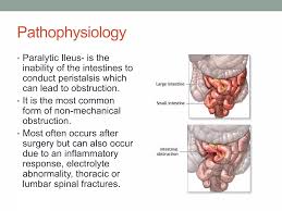 Image result for Adynamic Ileus