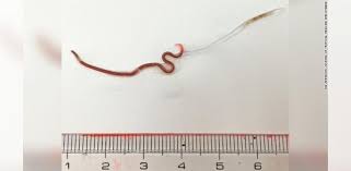 Maybe you would like to learn more about one of these? Doktor Keluarkan Cacing Hidup Dari Tonsil Wanita Sinar Plus