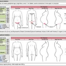 Image result for Active Labor Anesthesia