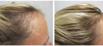 Low levels of it can cause hair loss, skin rashes, and brittle nails. Supplements With High Levels Of Vitamins For Women S Hair Loss Profollica Uk