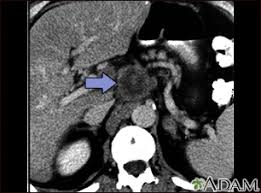 Doctors use ct scans to look at blood clots, tumors, bone fractures, and more. Abdominal Ct Scan Information Mount Sinai New York