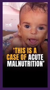Doctor Ahmad al-Farra, head of paediatrics at Nasser Hospital, says that  Sila Barbakh, an 11-month-old baby, is suffering from acute malnutrition  due to insufficient calorie intake., Al-Farra ...