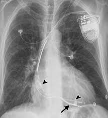 Icd ( implantable cardiac defibrillator) on the other hand senses a very fast or chaotic rhythm, known as ventricular fibrillation, and gives an electrical. Radiography Of Cardiac Conduction Devices A Comprehensive Review Radiographics