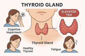 Image result for Subclinical Hyperthyroidism