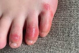 Athlete's foot is an itchy and red rash that usually affects the soles of the feet and between the hand, foot, and mouth disease. Itchy Red Rashes Indicating Virus Health And Science The Journal Gazette