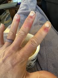 Image result for Chilblains