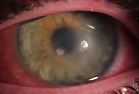 Image result for Keratitis
