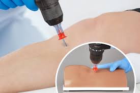 Image result for Intraosseous Access