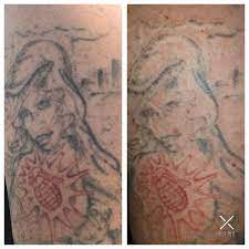Laser is one of the most popular ways to rid yourself of an unwanted tattoo. Tattoo Removal 1st Session