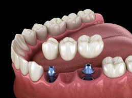 dental bridge mini dental implants dental bridge dental implants