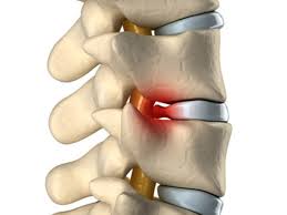 This might sound like this! 6 Tips For Relieving Pain From Herniated Discs Rehab Access Rehab Access