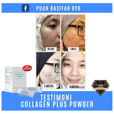 Jerawat batu adalah jerawat yang cukup menggangu dengan peradangan hebat yang berkumpul di bagian wajah. Testimoni Collagen Shaklee Parut Jerawat Hilang Dalam 3 Minggu Vitamin Syaza