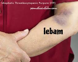 Penyakit itp adalah singkatan dari idiopathic thrombocytopenic purpura, gangguan kekebalan tubuh dengan ciri darah tidak bisa membeku sebagaimana mestinya. Good Health For Life Apakah Itu Penyakit Itp Adakah Cara Untuk Merawatnya Anda Perlu Ketahuinya
