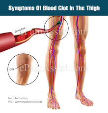 Sudden breathlessness, sharp chest pain (may be worse when you breathe in) and a cough or coughing up blood. Symptoms Of Blood Clot In Thigh Its Treatments