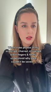 Andddddd that answered all of my questions 💀 #survivor #burnssurvivor  #eruptionsurvivor #burns #recovery #whiteislanderuption #burnsurvivor  #volcanoeruptionsurvivor #volcanoeruption #qna #askstephy ...