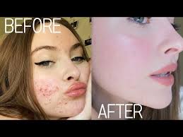 How I Cleared My Skin (and acne scars!)