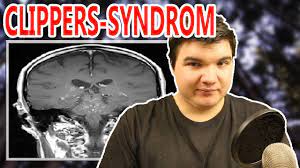 Ein kribbeln im kopf kann in seltenen fällen auf das diagnose: Clippers Syndrom 8 Menschen Weltweit Sind Davon Betroffen Sakultalks Youtube