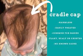 Image result for Cradle Cap
