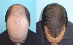 When used as directed, therefore, you will promote hair growth with no side effects. Essential Oils For Hair Loss Cedarwood Lavender Rosemary And Thyme Allaboutemu