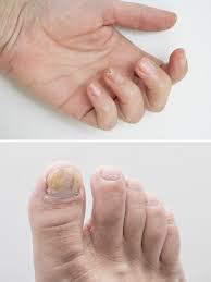 Image result for Yellow nail syndrome feet
