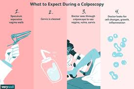 Image result for Colposcopy Findings