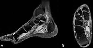 In addition, an image of all the muscles of the back and plantar part of the foot, all tendons and tendon ligaments, blood vessels and nerves are obtained. Isolated Medial Plantar Neuropathy Caused By A Large Ganglion Cyst Diagnosed With Mri A Case Report Sciencedirect