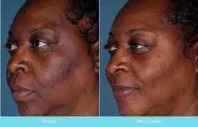 Image result for Melasma calycinum