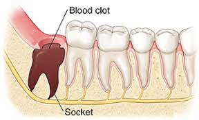 We did not find results for: Dry Socket