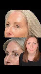 ✨ CO2 Laser ✨, Looking for a total skin rejuvenation? CO2 Laser might be  just what you need! 🙌 This treatment targets damaged skin, stimulating  collagen production and revealing smoother, healthier ...