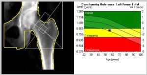 Dxa Test What You Must Know The Suppers Programs