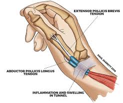 Synovial fluid, produced by the tendon sheath, maintains a barrier of moisture, which protects and lubricates tendons and their. Dequervain S Tenosynovitis Hand Wrist Surgeon Perth
