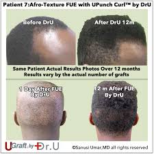 Hair transplant surgery for men may differ in how hair follicles are extracted from the donor site. Dr Sanusi Umar Invents New Hair Restoration Tools For Afro Textured Hair Fue Hair Transplants Possible For Tight Curly Hair Plastic And Reconstructive Surgery Journal