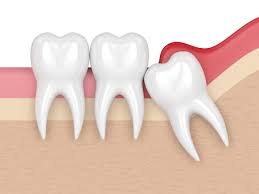 Nov 13, 2020 · how to know if my wisdom teeth are coming out. 5 Signs That Your Wisdom Teeth Are Coming In