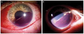 Image result for Hyphema