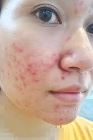 Obat untuk menghilangkan bekas jerawat dengan cepat yang bisa di beli di apotik selanjutnya adalah verile acne blemish cream 10g. Saya Berjaya Hilangkan Jerawat Selepas 13 Tahun Bertarung